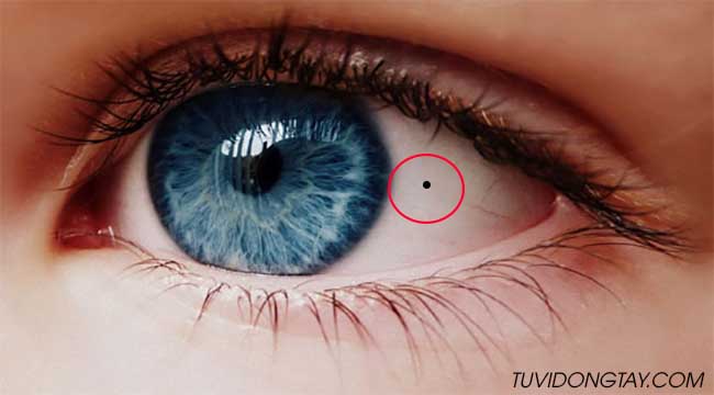 Mụn ruồi trong mắt nói lên điều gì? 